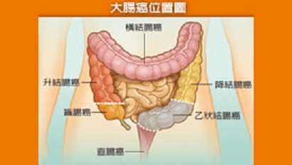 大腸癌的確可能會有某些症狀,但有症狀基本上要到第二期、甚至第三期以上,而早期大腸癌幾乎沒有症狀。 大腸癌的確可能會有某些症狀,但有症狀基本上要到第二期、甚至第三期以上,而早期大腸癌幾乎沒有症狀。