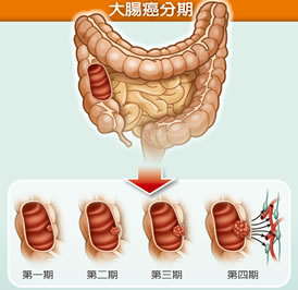 大腸癌的確可能會有某些症狀,但有症狀基本上要到第二期、甚至第三期以上,而早期大腸癌幾乎沒有症狀。 大腸癌的確可能會有某些症狀,但有症狀基本上要到第二期、甚至第三期以上,而早期大腸癌幾乎沒有症狀。