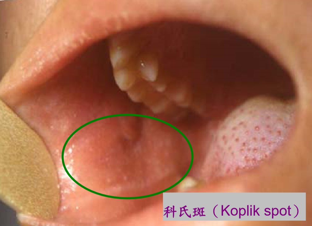麻疹患者口腔內會出現斑點。 圖 : 台中市衛生局/提供 麻疹患者口腔內會出現斑點。 圖 : 台中市衛生局/提供
