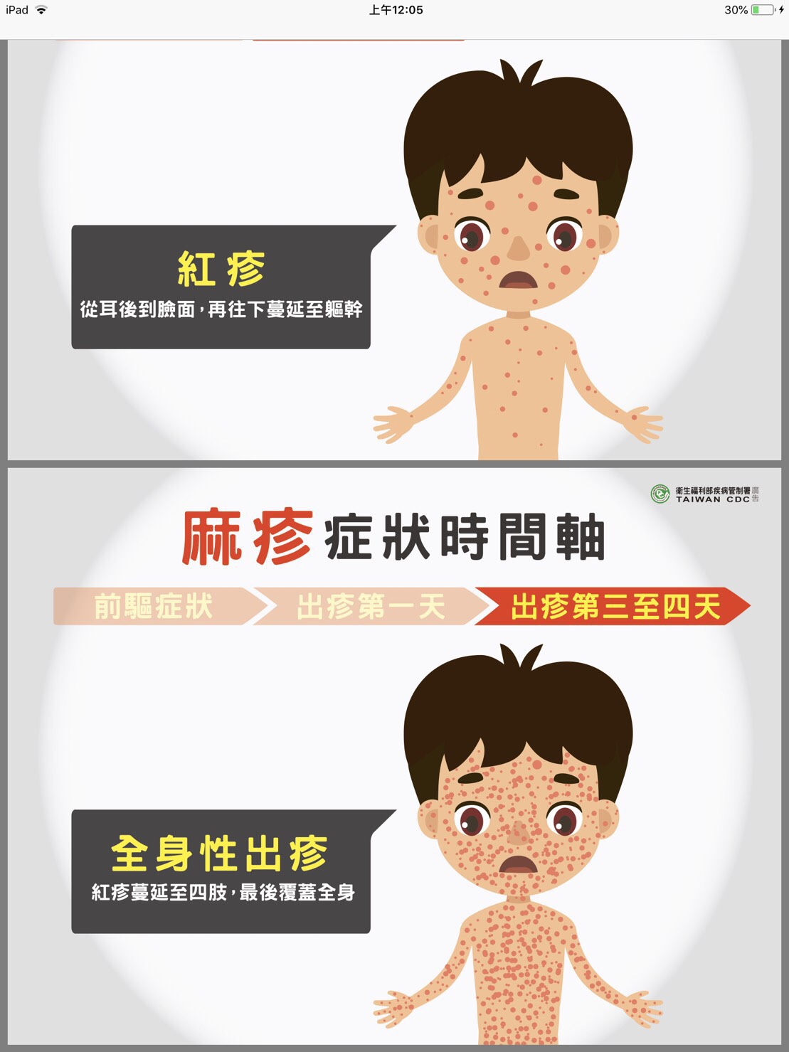 長出柯氏斑點後,緊接著耳後會出現典型的「斑丘疹」,之後再擴散長滿整個臉面,斑丘疹並會由上向下、從頭長到腳遍布全身。
圖:衛福部疾管署提供 長出柯氏斑點後,緊接著耳後會出現典型的「斑丘疹」,之後再擴散長滿整個臉面,斑丘疹並會由上向下、從頭長到腳遍布全身。
圖:衛福部疾管署提供