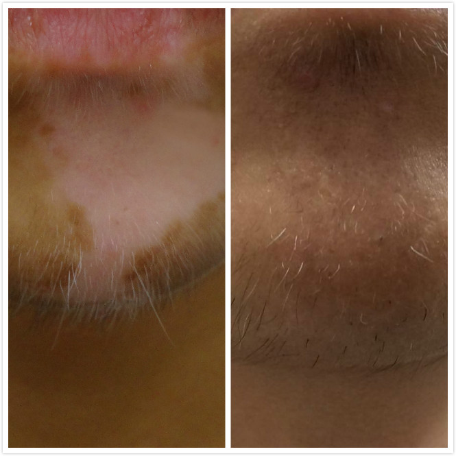 左邊為治療前，右邊為經治療後長出黑色鬍鬚。