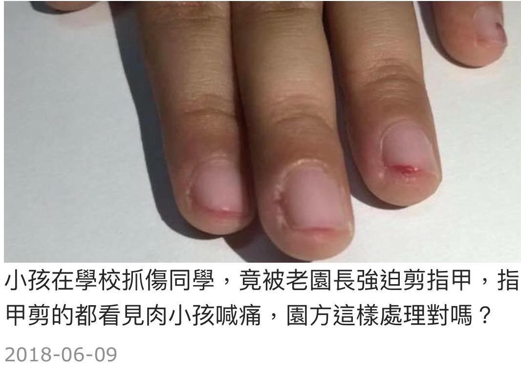 女童家長懷疑園方虐童動私刑,家長說,事發當天園方來家裡道歉,女兒不說話當場一直掉淚,當時老園長解釋「我自己的手腳都會剪成這樣了,我眼睛不好」。
女童家長懷疑園方虐童動私刑,家長說,事發當天園方來家裡道歉,女兒不說話當場一直掉淚,當時老園長解釋「我自己的手腳都會剪成這樣了,我眼睛不好」。