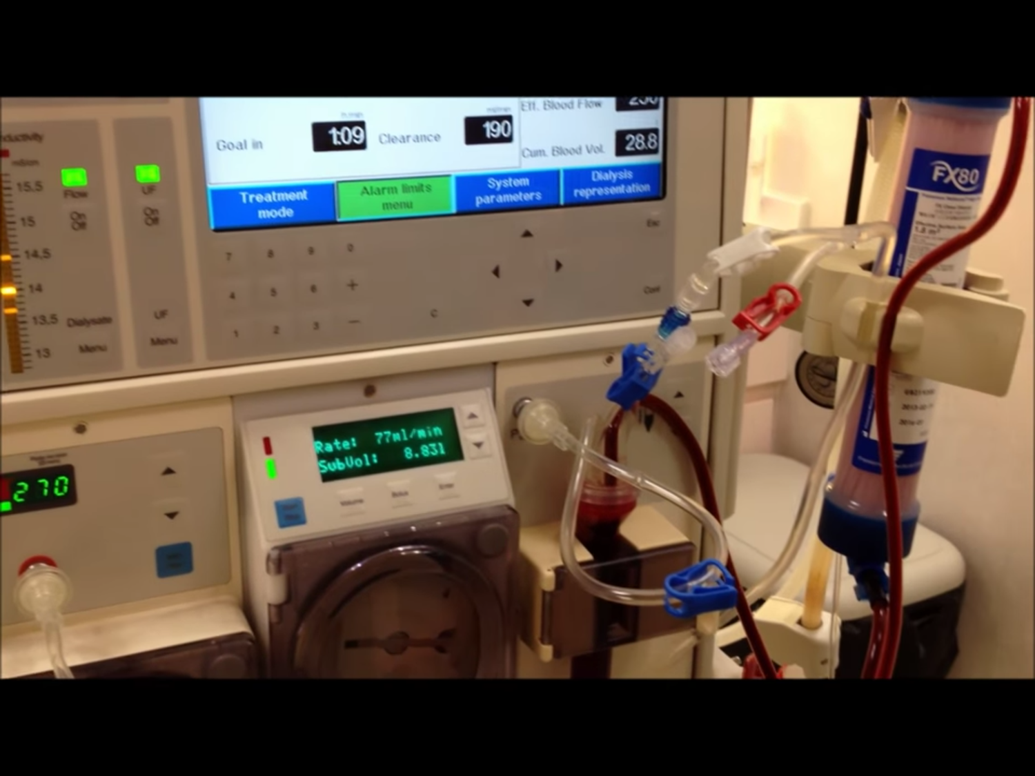 台大醫院加護病房發生替重症患者洗腎時,誤將自來水當成RO逆滲透水使用,共有6名患者受影響,其中一人事發後死亡。但台大內部調查證據顯示,接錯管路和病人死亡無關。圖為一般洗腎設備,但與這次台大醫院出錯案例無關。 圖:翻攝自Youtube 台大醫院加護病房發生替重症患者洗腎時,誤將自來水當成RO逆滲透水使用,共有6名患者受影響,其中一人事發後死亡。但台大內部調查證據顯示,接錯管路和病人死亡無關。圖為一般洗腎設備,但與這次台大醫院出錯案例無關。 圖:翻攝自Youtube