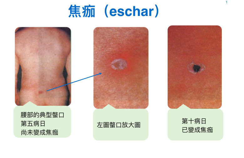 被恙蟎叮咬的地方會出現焦痂。 圖:衛福部疾病管制署/提供 被恙蟎叮咬的地方會出現焦痂。 圖:衛福部疾病管制署/提供
