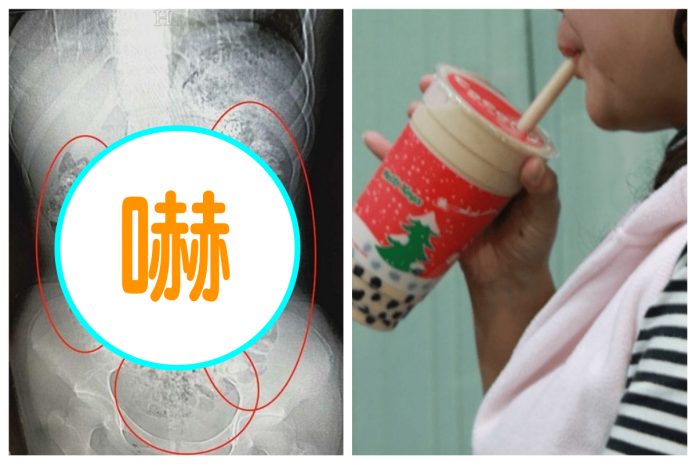▲少女因為腹痛到醫院照電腦斷層掃描,驚見肚子裡有上百顆「顆粒狀陰影」,讓人看了頭皮發麻。 合成圖/翻攝自浙江新聞/NOWnews 資料圖片 ▲少女因為腹痛到醫院照電腦斷層掃描,驚見肚子裡有上百顆「顆粒狀陰影」,讓人看了頭皮發麻。 合成圖/翻攝自浙江新聞/NOWnews 資料圖片