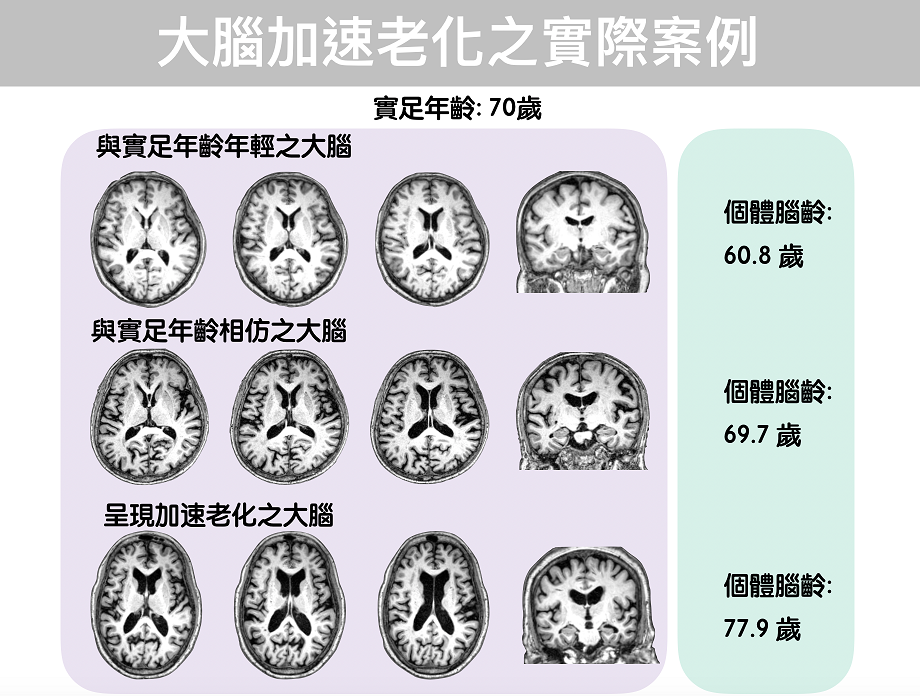 人類腦齡估算一直以來都是用實足年齡作為參考依據,但是人腦會隨著年齡增長逐漸老化,伴隨認知功能下降、行為改變與臨床病變等。 圖 : 陽明大學提供 人類腦齡估算一直以來都是用實足年齡作為參考依據,但是人腦會隨著年齡增長逐漸老化,伴隨認知功能下降、行為改變與臨床病變等。 圖 : 陽明大學提供