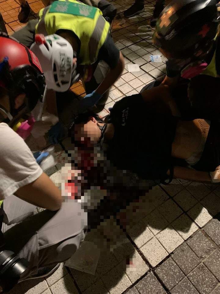 香港一名15少年遭疑警方催淚彈射中頭部,導致顱骨骨折情況危殆。/圖 : 翻攝自香港連登討區 香港一名15少年遭疑警方催淚彈射中頭部,導致顱骨骨折情況危殆。/圖 : 翻攝自香港連登討區