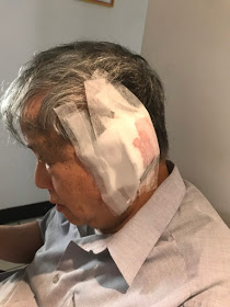監委陳師孟上週開刀割除了左耳背上的一顆惡性腫瘤,所幸經過進一步切片化驗之後,得知癌細胞沒有擴散,讓他心中寬心不少, 圖:擷取自陳師孟的尖尾週記。 監委陳師孟上週開刀割除了左耳背上的一顆惡性腫瘤,所幸經過進一步切片化驗之後,得知癌細胞沒有擴散,讓他心中寬心不少, 圖:擷取自陳師孟的尖尾週記。