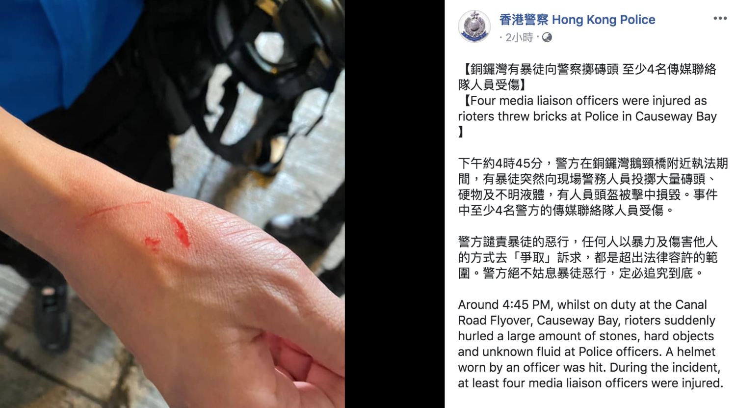 香港警察在臉書貼出警方傳媒聯絡隊人員受傷照片。 圖:翻攝自「香港警察」 香港警察在臉書貼出警方傳媒聯絡隊人員受傷照片。 圖:翻攝自「香港警察」