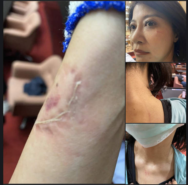 林楚茵控告國民黨立委呂玉玲咬傷自己。 圖:取自林楚茵臉書 林楚茵控告國民黨立委呂玉玲咬傷自己。 圖:取自林楚茵臉書