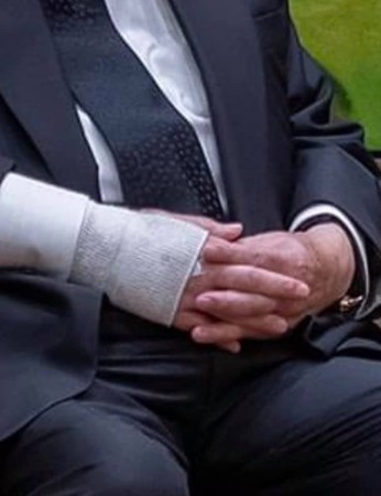 陳耀昌指出,森喜朗他的右手肘紗布下,有個「靜脈留置針」,還有墊針頭的酒精綿球露出一小部分。 圖:翻攝蔡英文推特 陳耀昌指出,森喜朗他的右手肘紗布下,有個「靜脈留置針」,還有墊針頭的酒精綿球露出一小部分。 圖:翻攝蔡英文推特