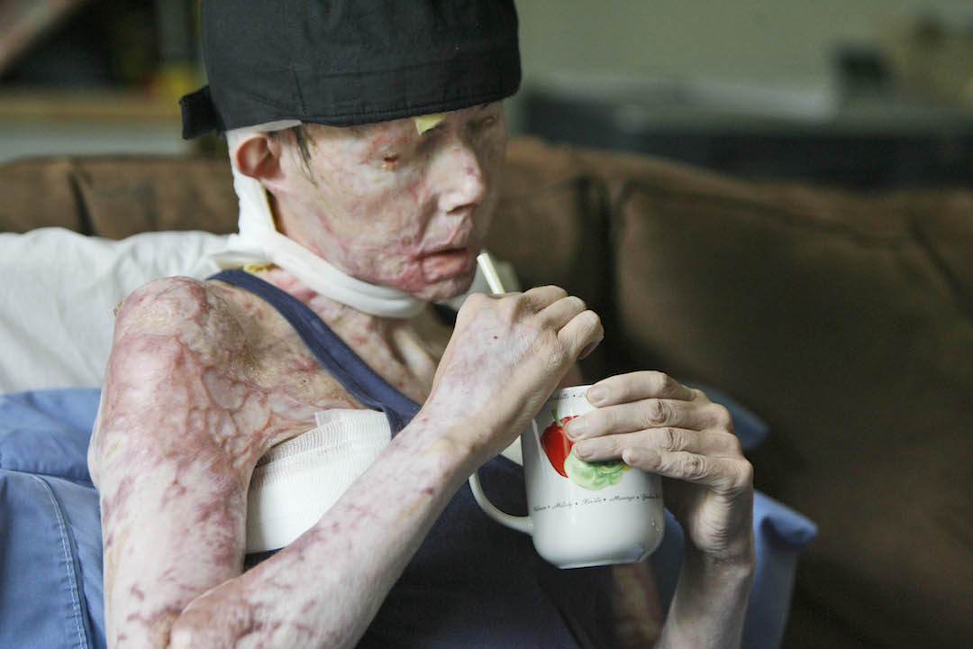 在2007年塔雷頓的丈夫用強鹼溶液攻擊她,導致臉部溶解、身體約80%燒傷。 圖 : 達志影像/美聯社 在2007年塔雷頓的丈夫用強鹼溶液攻擊她,導致臉部溶解、身體約80%燒傷。 圖 : 達志影像/美聯社