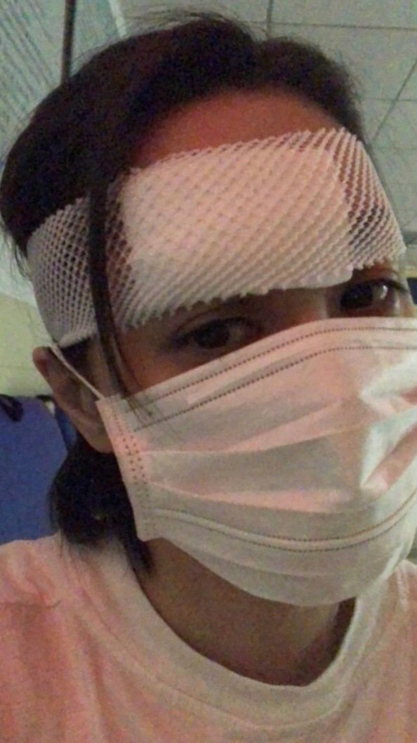 阿嬌經紀人表示,她的頭破了一個6公分的大洞,從內層肌肉到表皮總共縫了數十針。 圖:翻攝微博 阿嬌經紀人表示,她的頭破了一個6公分的大洞,從內層肌肉到表皮總共縫了數十針。 圖:翻攝微博