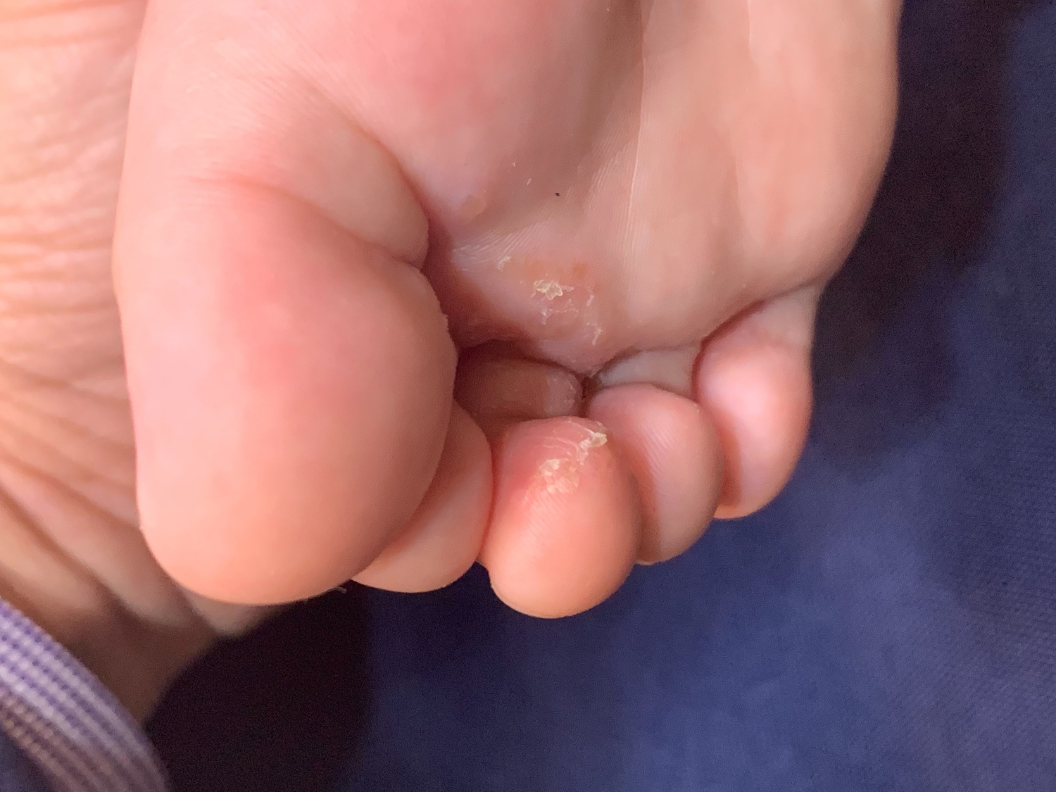 2歲童驚染香港腳！醫生：家中地板成黴菌播種地