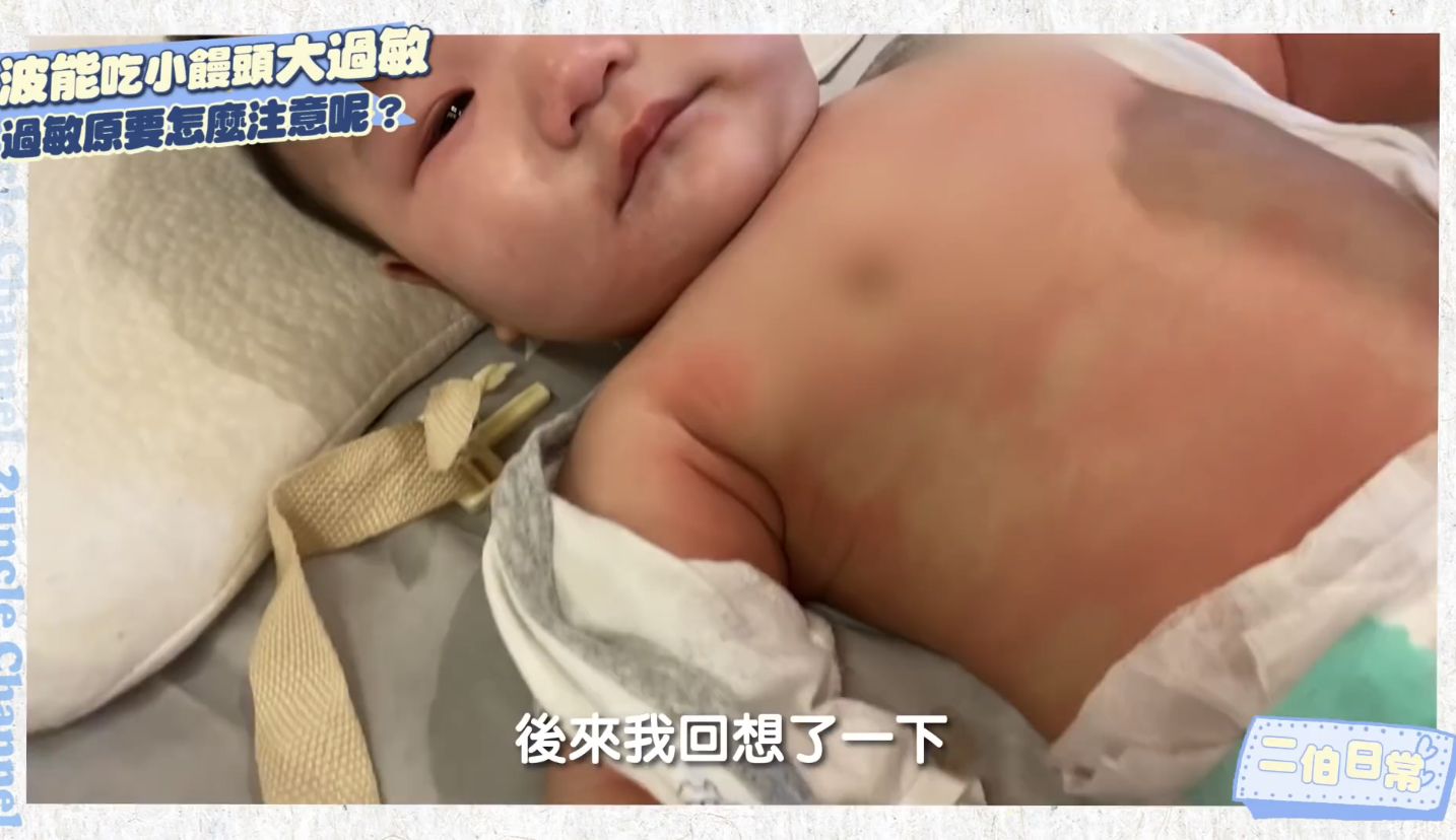 蔡波能因過敏導致全身發紅。 圖:翻攝自嘎嫂二伯&蔡波能`s Daily 蔡波能因過敏導致全身發紅。 圖:翻攝自嘎嫂二伯&蔡波能`s Daily