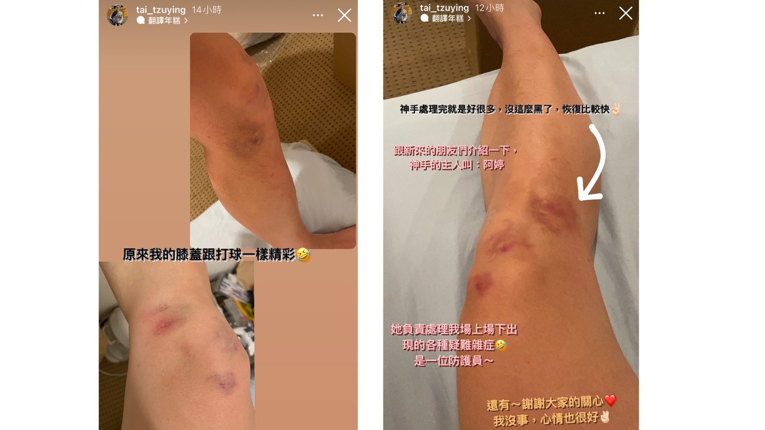 戴資穎分享目前的膝蓋的狀況,感謝防護員的「神手」。 圖:擷取自戴資穎IG 戴資穎分享目前的膝蓋的狀況,感謝防護員的「神手」。 圖:擷取自戴資穎IG