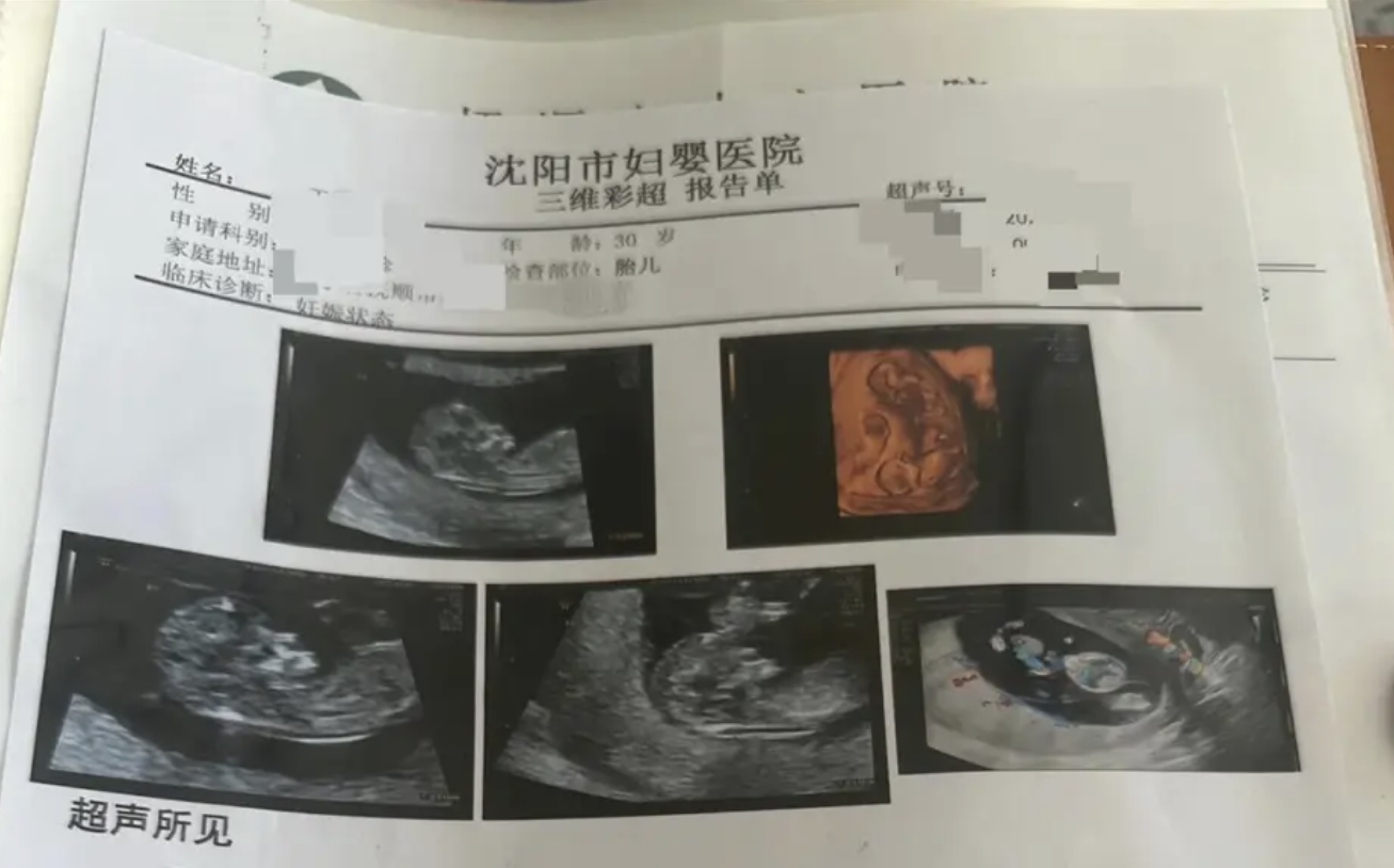 產檢一次多一胎! 罕見同卵四胞胎 遼寧女懷孕16週 第四胎為無心畸胎