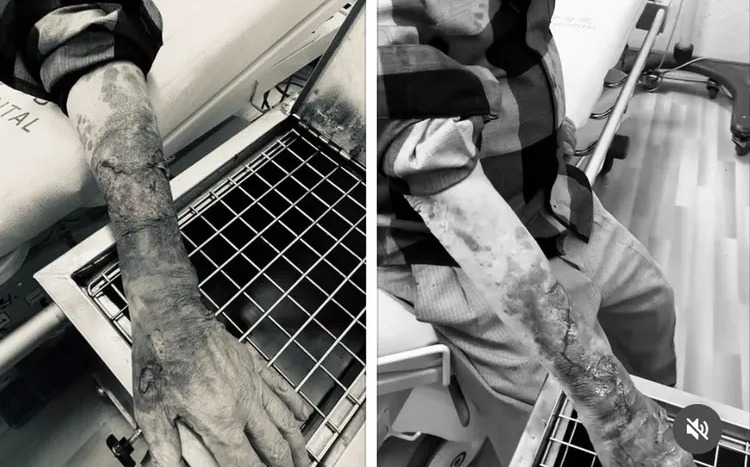 台中老翁行車糾紛遭毆 雙手皮開肉綻!打人者辯:沒打方向燈很危險