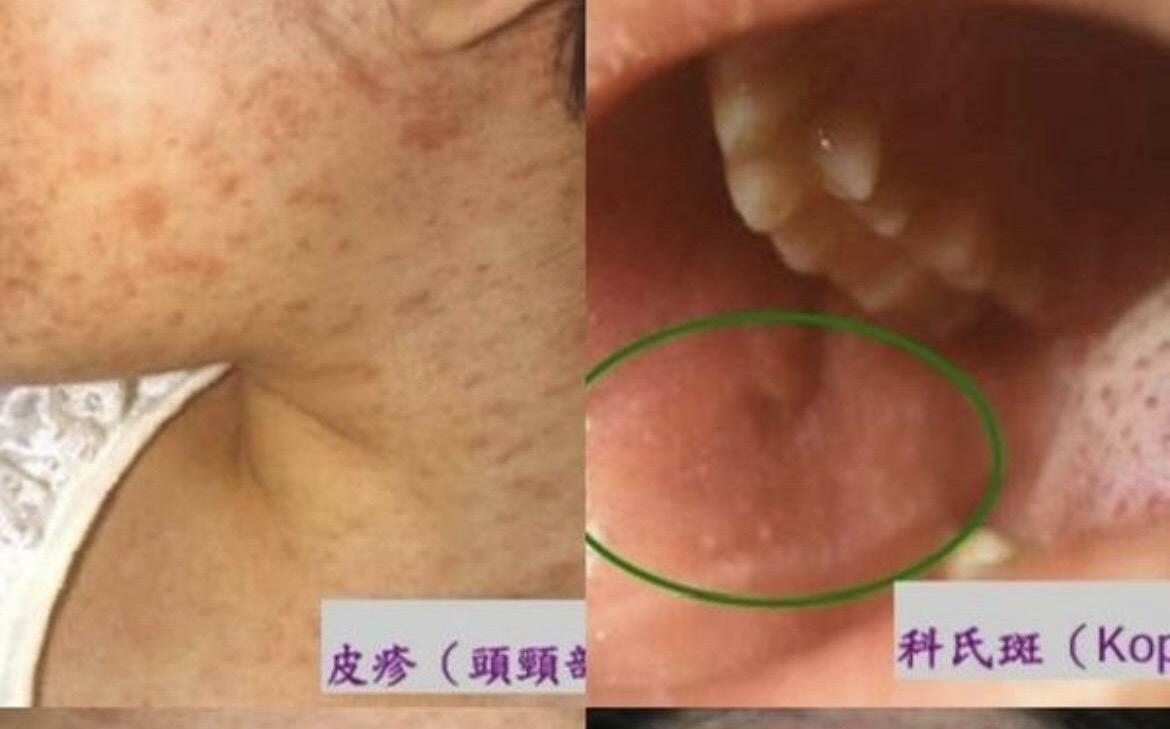 今年首起境外移入麻疹群聚 疾管署公布旅遊警示區