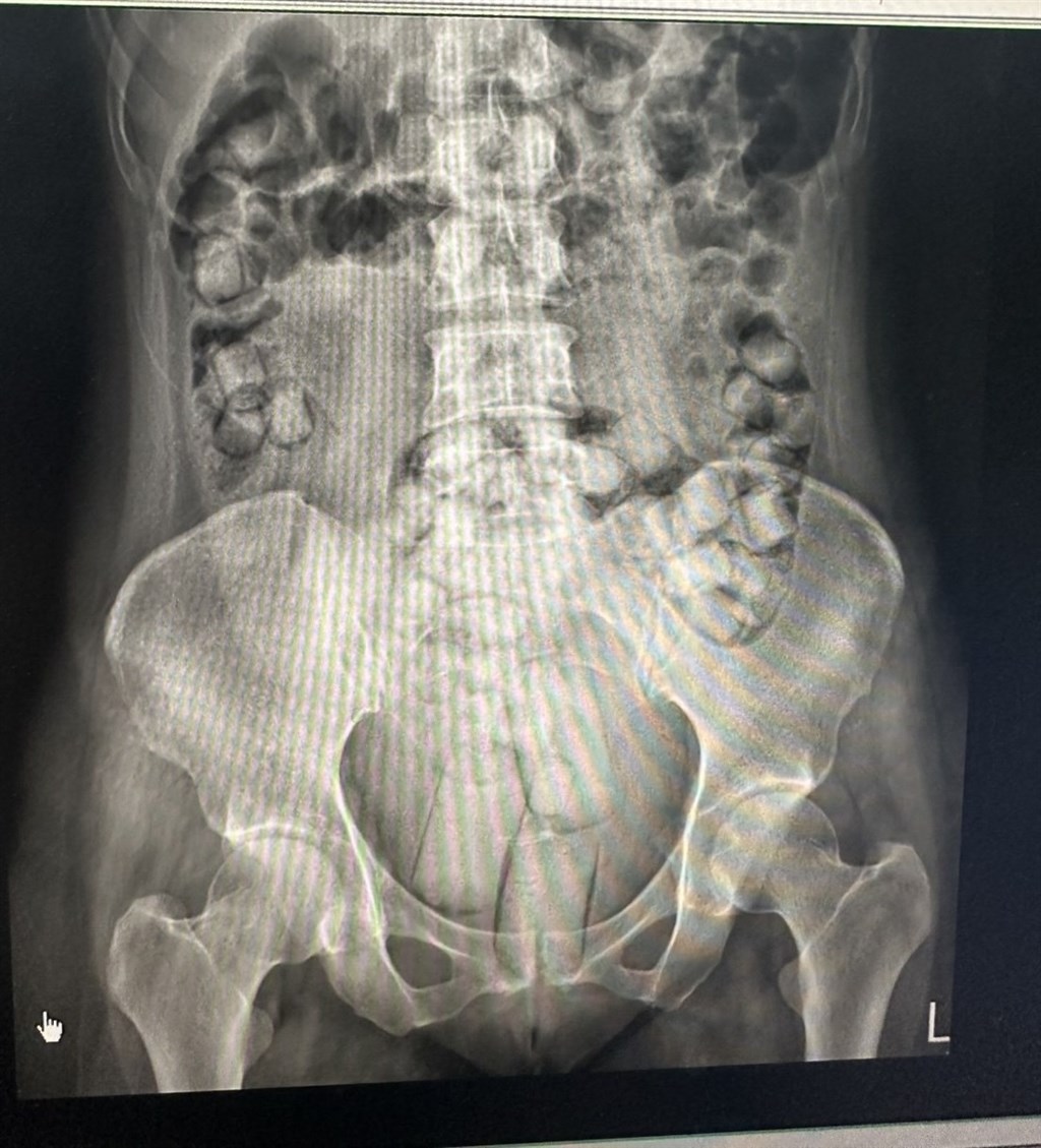 2泰女吞藏海洛因小港機場遭攔現形 一審最重判16年