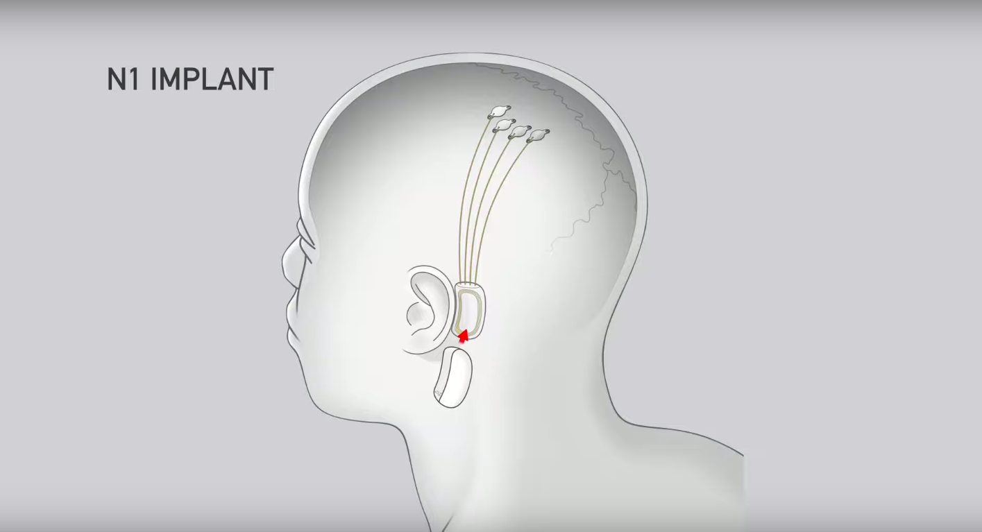 人腦未來將接上網路？馬斯克新項目，將晶片無痛植入人腦中。   圖：Neuralink／YouTube