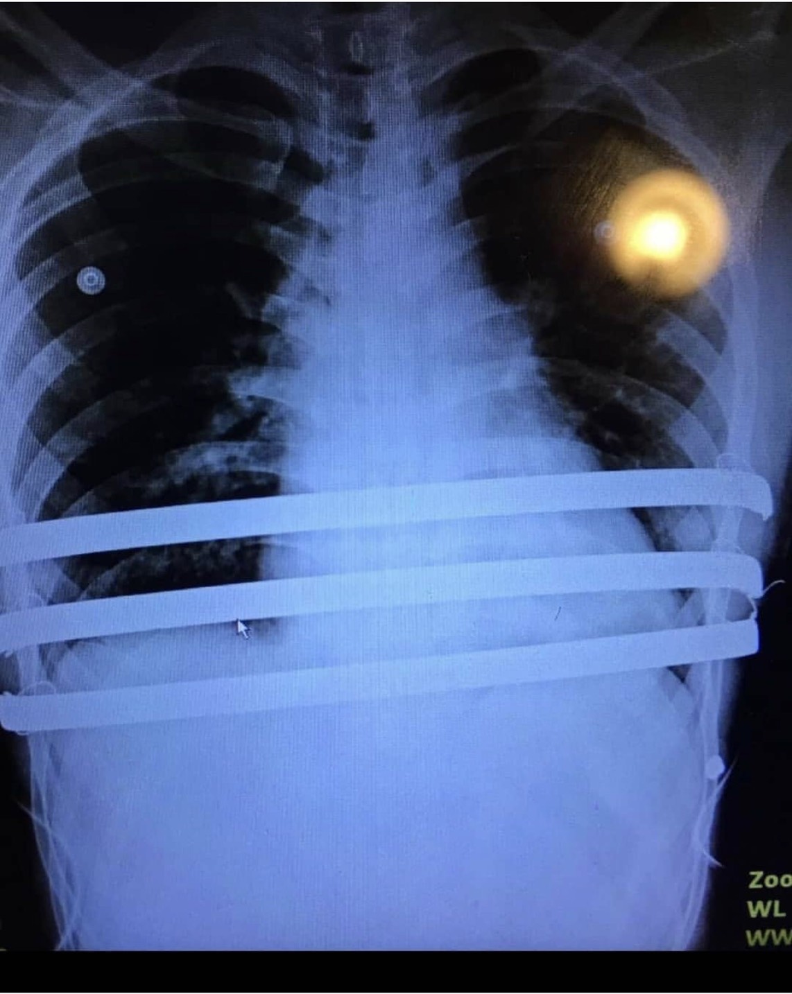 樓峻碩開刀前先照X光，確認4年前因矯正先天性漏斗胸而裝進胸腔的3根鐵條。   圖：翻攝Instagram