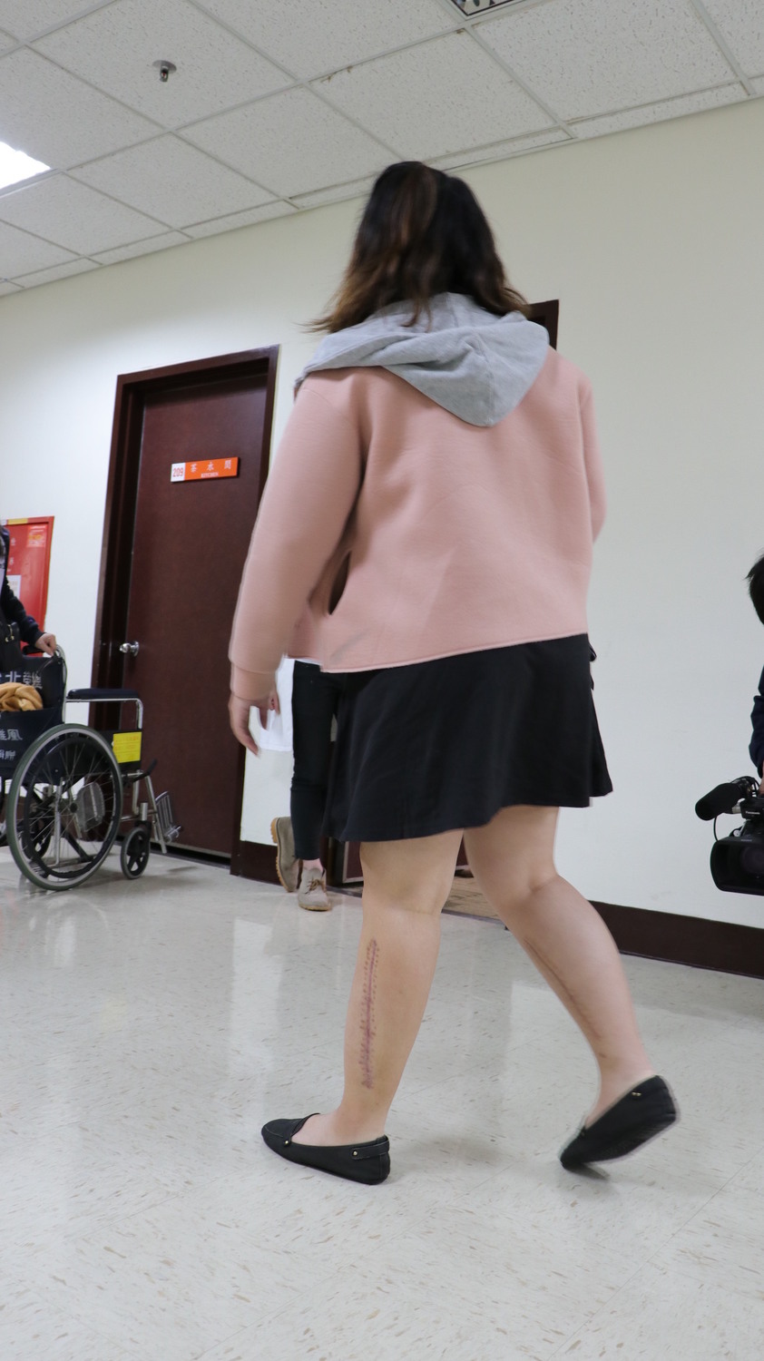 恐因心臟黏液瘤多處栓塞需截肢！北榮醫療團隊24小時接力 救回22歲女子雙腳
