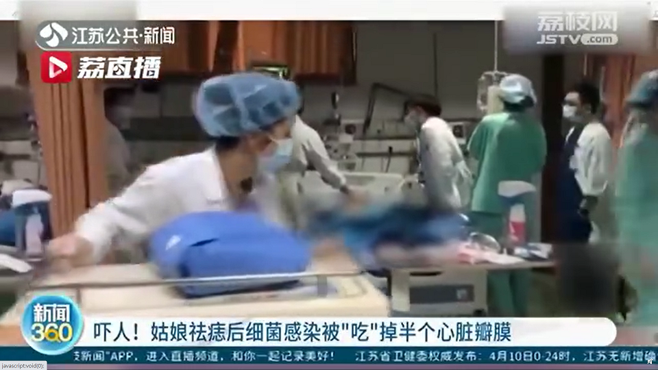 中國浙江一個20歲女生小丁因為做除痣手術，患上「感染性心內膜炎」。   圖：翻攝自微博