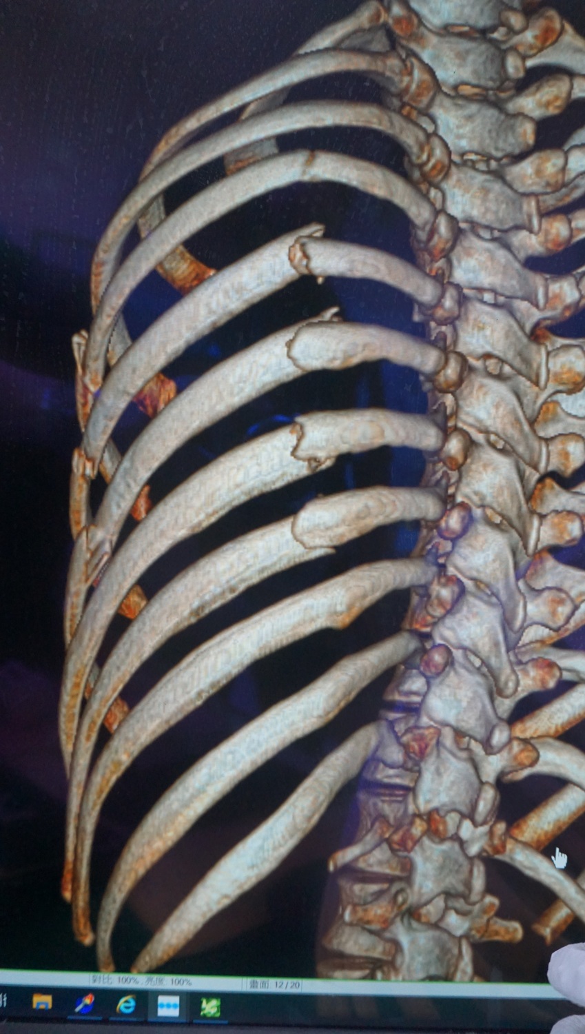3d列印助攻見成效掌握肋骨骨折手術黃金時間不再擔心後遺症 生活 新頭殼newtalk