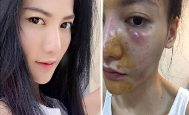 泰國美女在打美白針6年後出現臉部潰爛情形。   圖 : 翻攝自推特