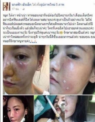 泰國美女在打美白針6年後出現臉部潰爛情形。   圖 : 翻攝自推特