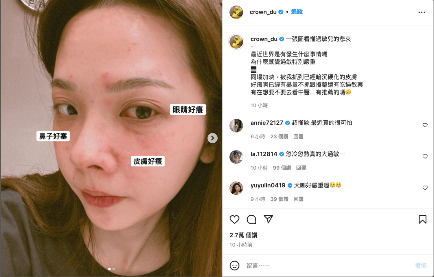換季秒爆發！滴妹皮膚狂冒紅疹 淚PO素顏照：特別嚴重