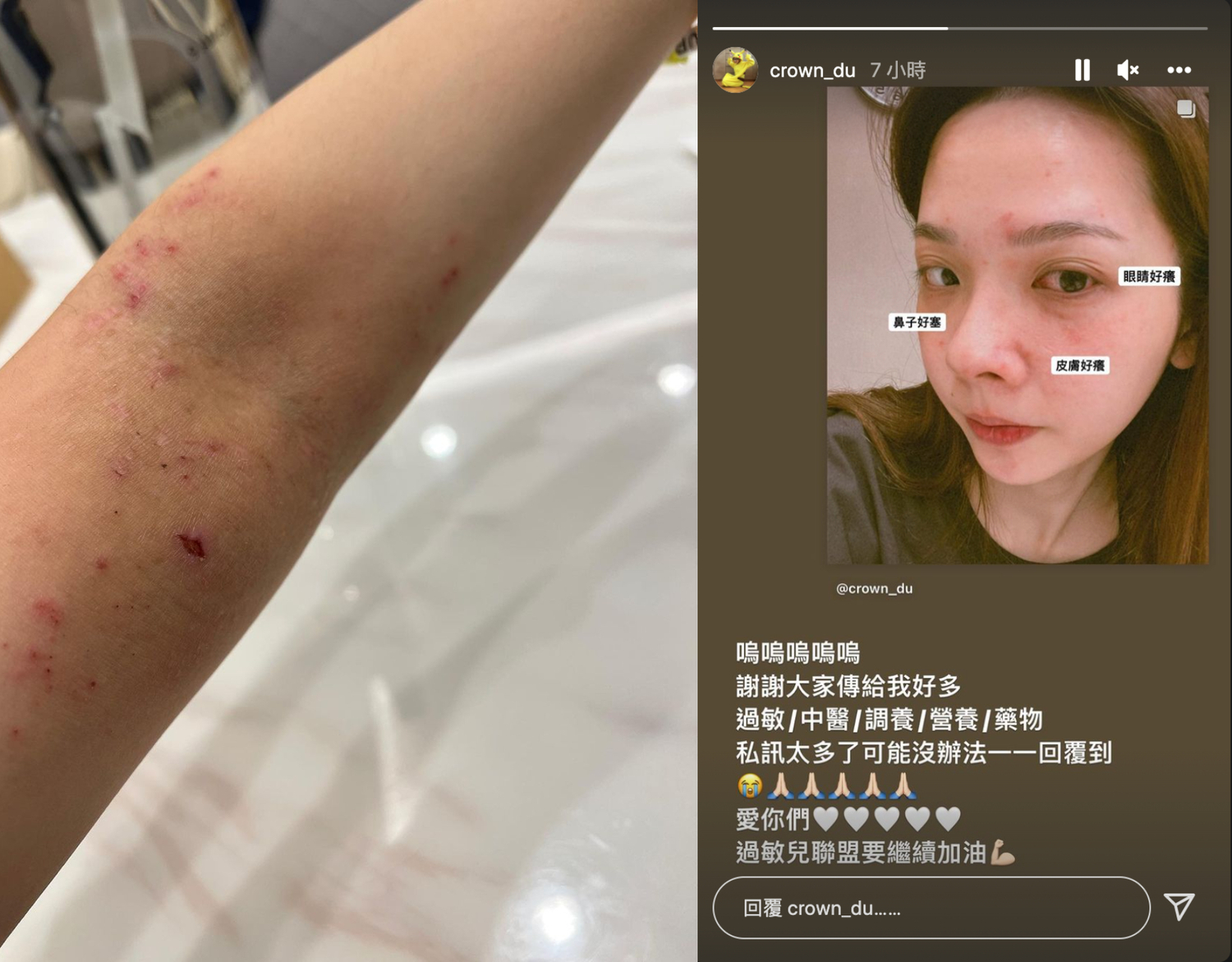 換季秒爆發！滴妹皮膚狂冒紅疹 淚PO素顏照：特別嚴重