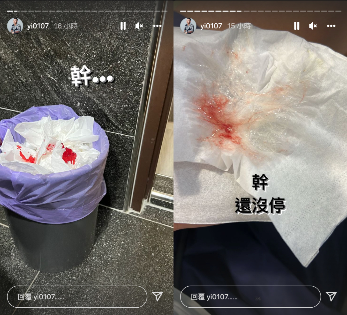 健康疑亮紅燈！鳳梨上廁所突「鼻血狂噴」急問：什麼情況？