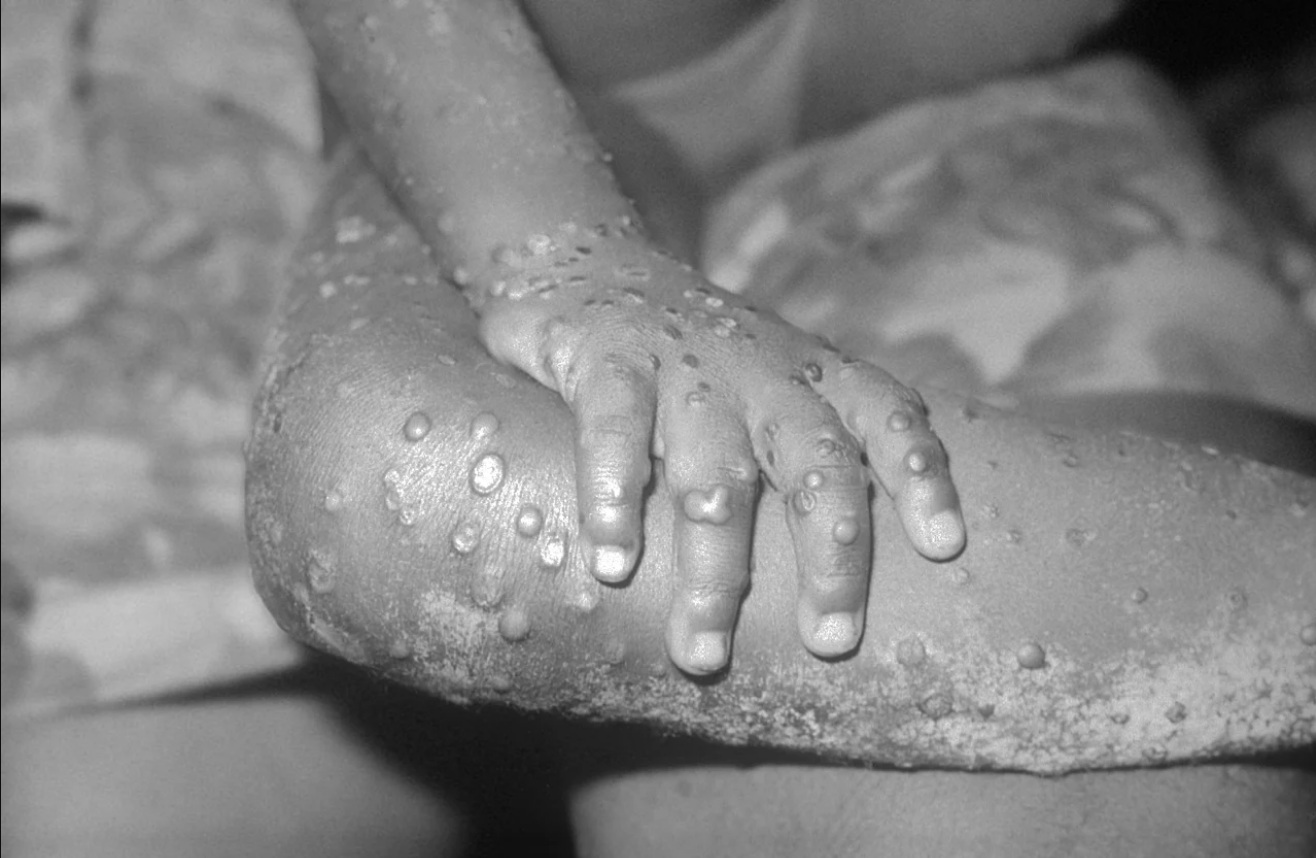 猴痘導致全身會出現看似丘疹膿皰或水泡的症狀。   圖：翻攝維基百科 / 公有領域（資料照片）