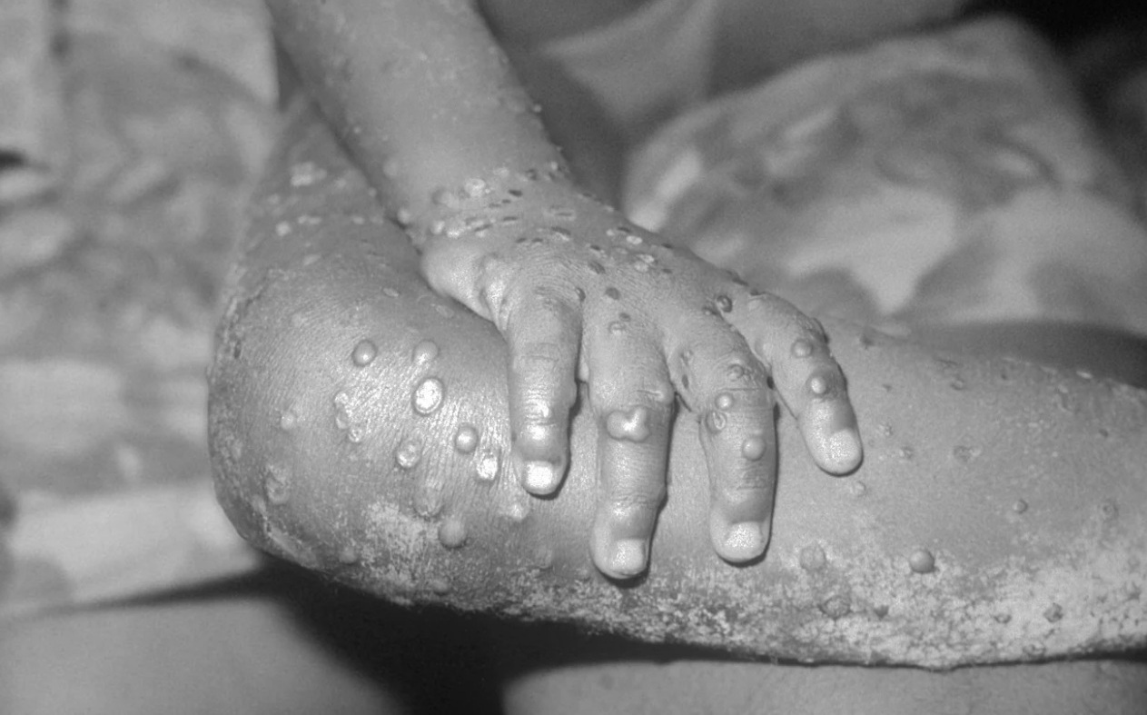 WHO：猴痘疫情尚未構成全球公衛緊急事件 | 國際 | Newtalk新