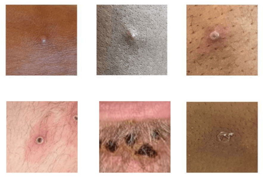 美國疾管署介紹感染猴痘皮膚出現症狀。   圖：翻攝cdc.gov