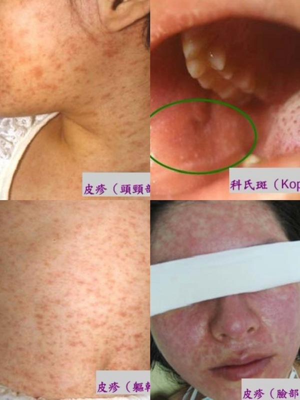 南卡羅來納州自上週五（24日）起新增八起麻疹確診病例。圖為麻疹狀況示意圖。 圖：高雄長庚醫院黃高彬部長、疾管署／提供 新頭殼合成 