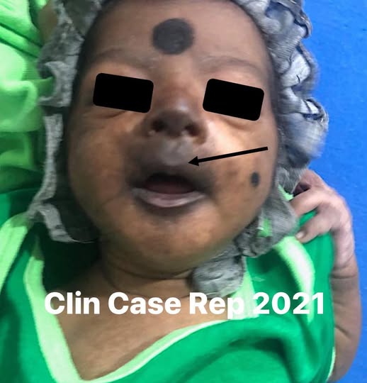 屈公病危害新生兒，曾有12天男嬰出現發燒與臉部發黑，確診為蚊媒感染。 圖：翻攝自來講兒科急診的543-吳昌騰醫師　臉書專頁 